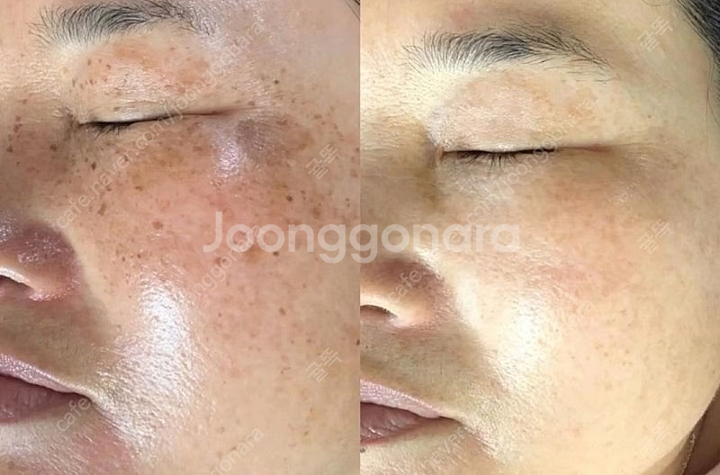 피코토닝 반영구레이저 토닝팝니다!--5