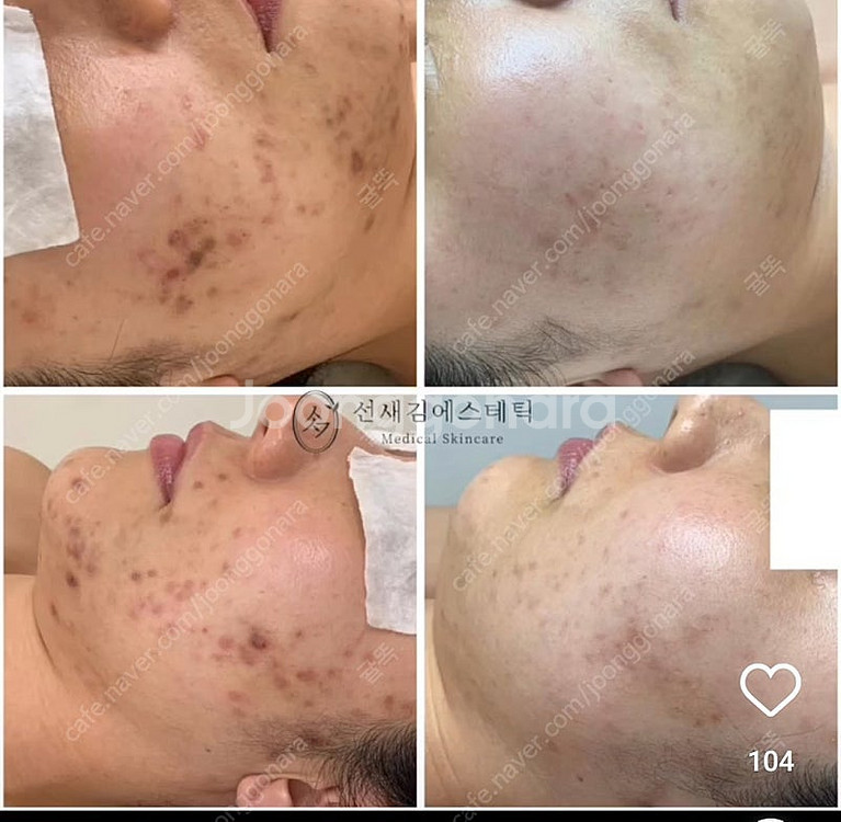 피코토닝 반영구레이저 토닝팝니다!--6