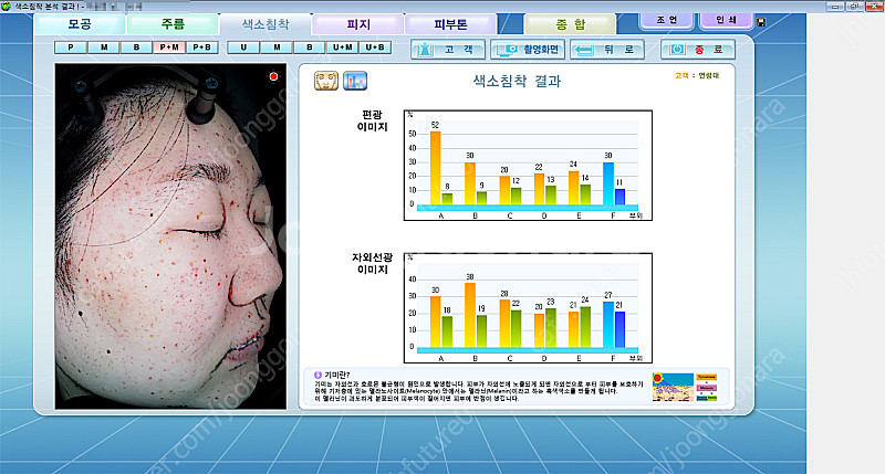 피부진단기 야누스2 안면검사기 피부분석기 JANUS-2--5