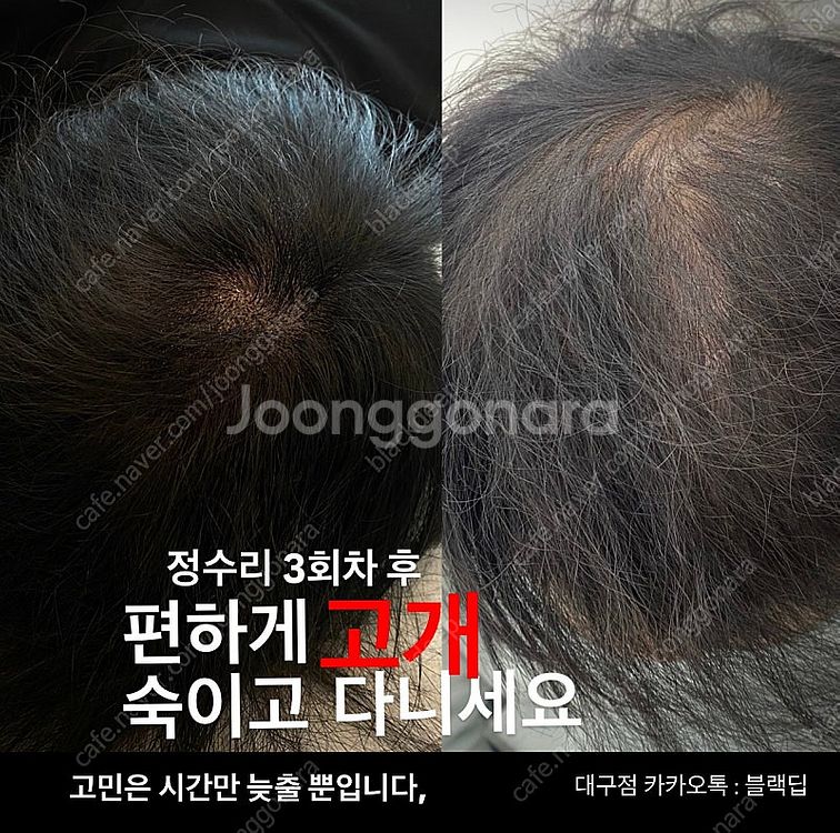 대구 두피문신 smp 가르마/정수리/헤어라인/탈모/m자...--0