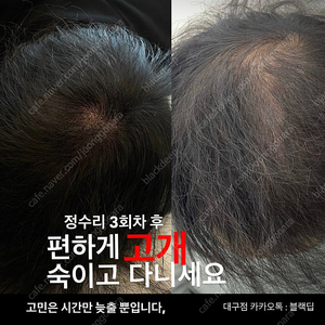 대구 두피문신 smp 가르마/정수리/헤어라인/탈모/m자 이벤트 모델