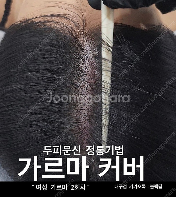 대구 두피문신 smp 가르마/정수리/헤어라인/탈모/m자...--3