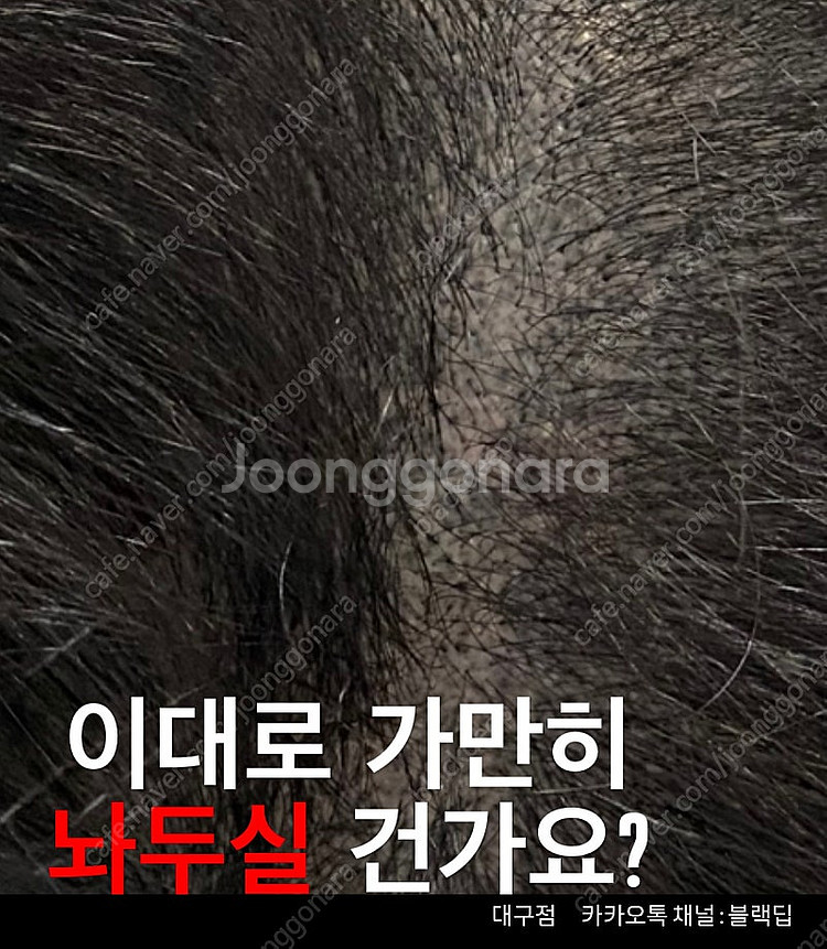 대구 두피문신 smp 가르마/정수리/헤어라인/탈모/m자...--4