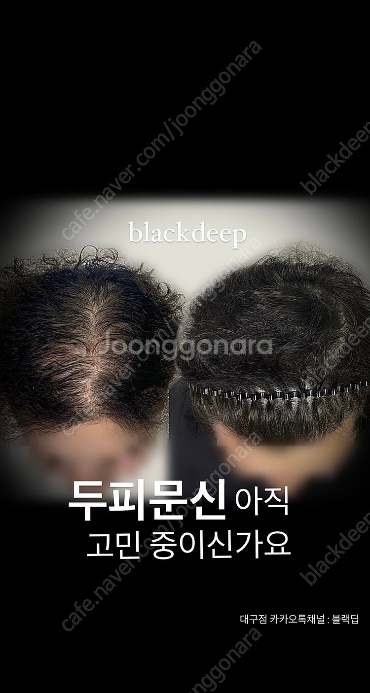 대구 두피문신 smp 가르마/정수리/헤어라인/탈모/m자...--5