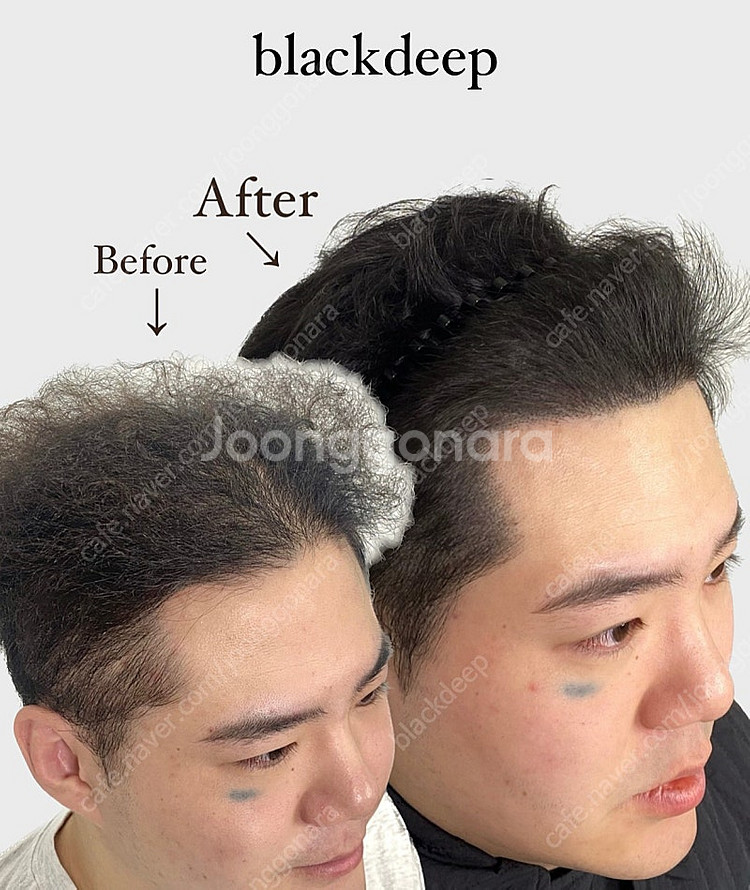 대구 두피문신 smp 가르마/정수리/헤어라인/탈모/m자...--8
