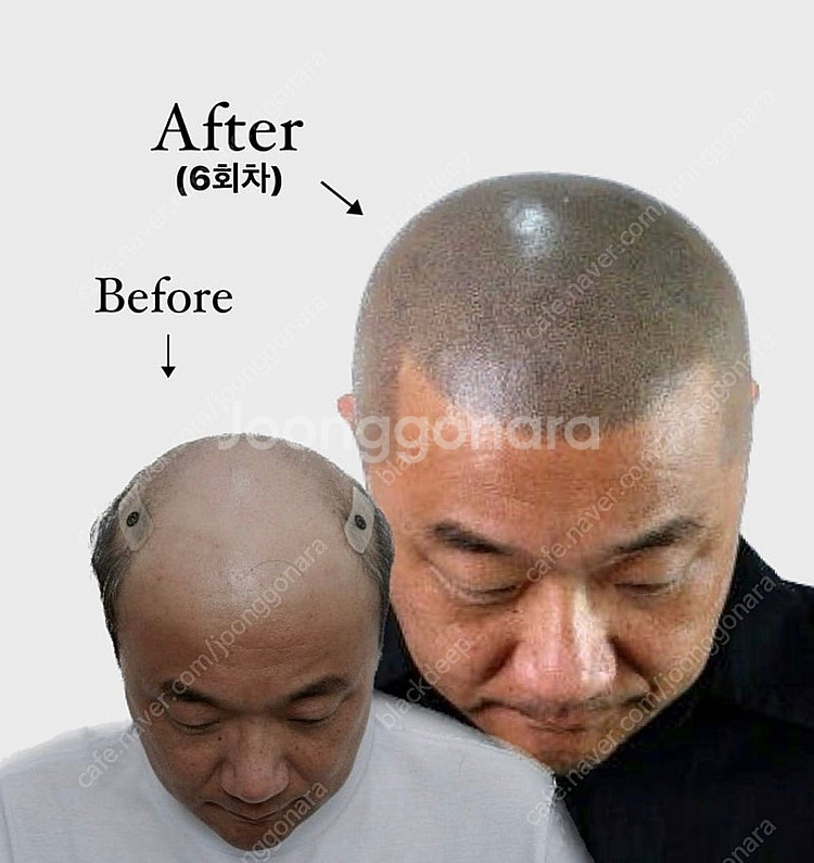 대구 두피문신 smp 가르마/정수리/헤어라인/탈모/m자...--9