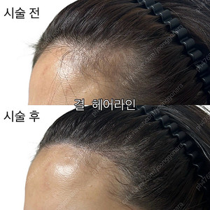 서울 중랑구) m자 이마, 헤어라인 탈모
