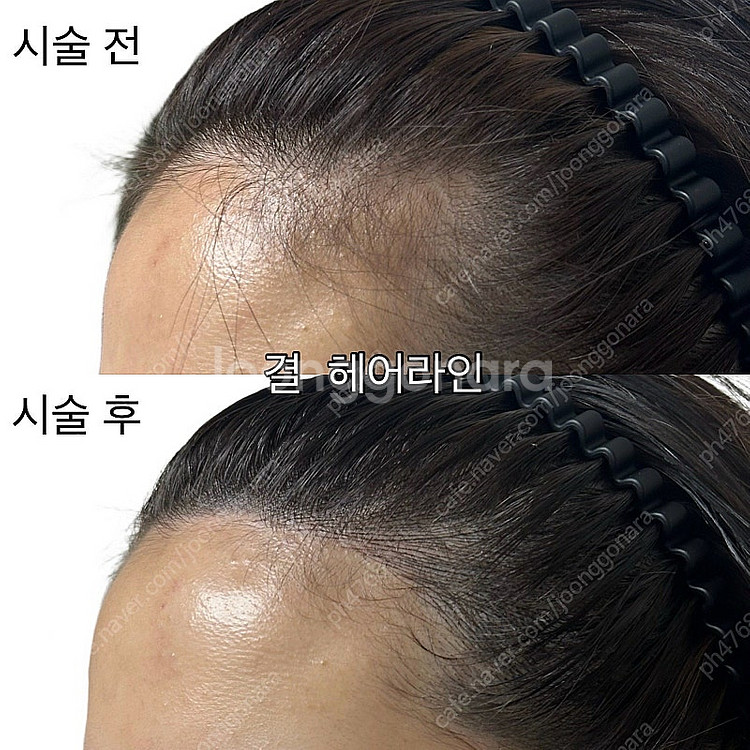 서울 중랑구) m자 이마, 헤어라인 탈모--0