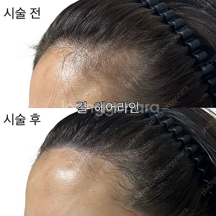 서울 중랑구) m자 이마, 헤어라인 탈모--0