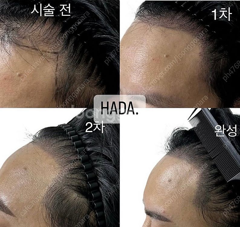 서울 중랑구) 정수리 ,가르마, 헤어라인 탈모--0
