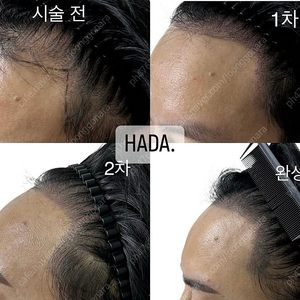 서울 중랑구) 정수리 ,가르마, 헤어라인 탈모