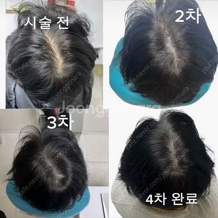 서울 중랑구) 정수리 ,가르마, 헤어라인 탈모--2