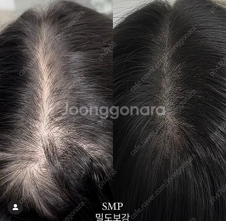 서울 중랑구) 정수리 ,가르마, 헤어라인 탈모--3