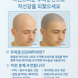 [면목동 출장 두피문신] 탈모·M자·헤어라인 자연 커버 시술합니다!
