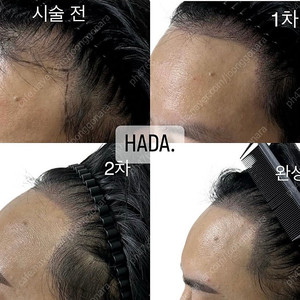 서울 중랑구) 정수리 ,가르마, 헤어라인 탈모