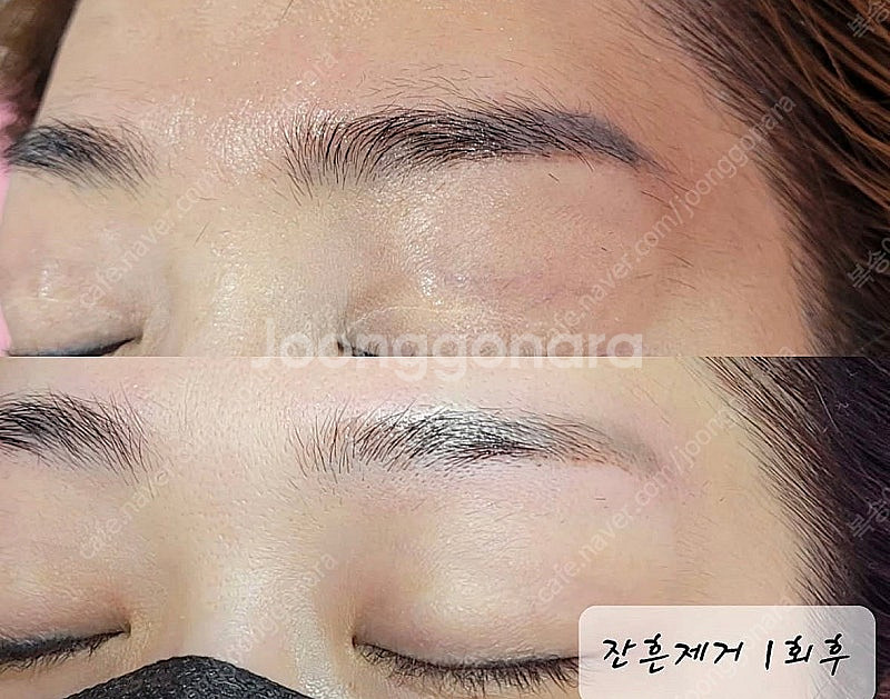 피코레이저--4