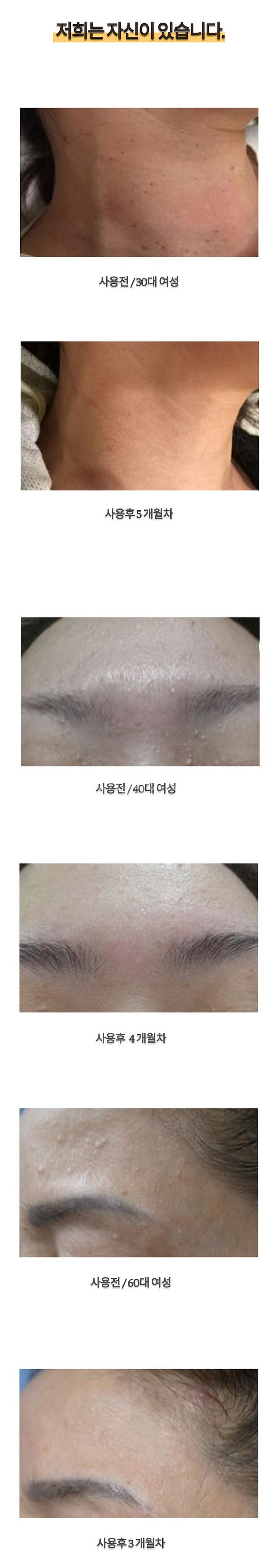 메디카미 실크 루미어 크림 (비립종 평편사마귀 좁쌀--4