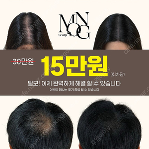 완벽한 탈모해결방법!!