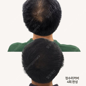 정수리탈모, 탈모로 고민 되신 다면!