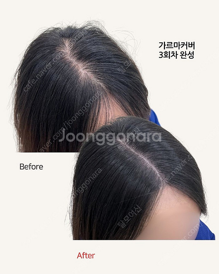 정수리, 가르마 탈모로 고민하신다면 이 상품!!--1