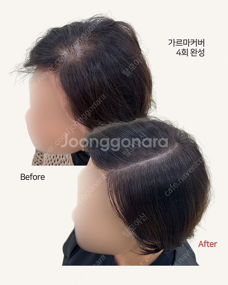 정수리, 가르마 탈모로 고민하신다면 이 상품!!--1