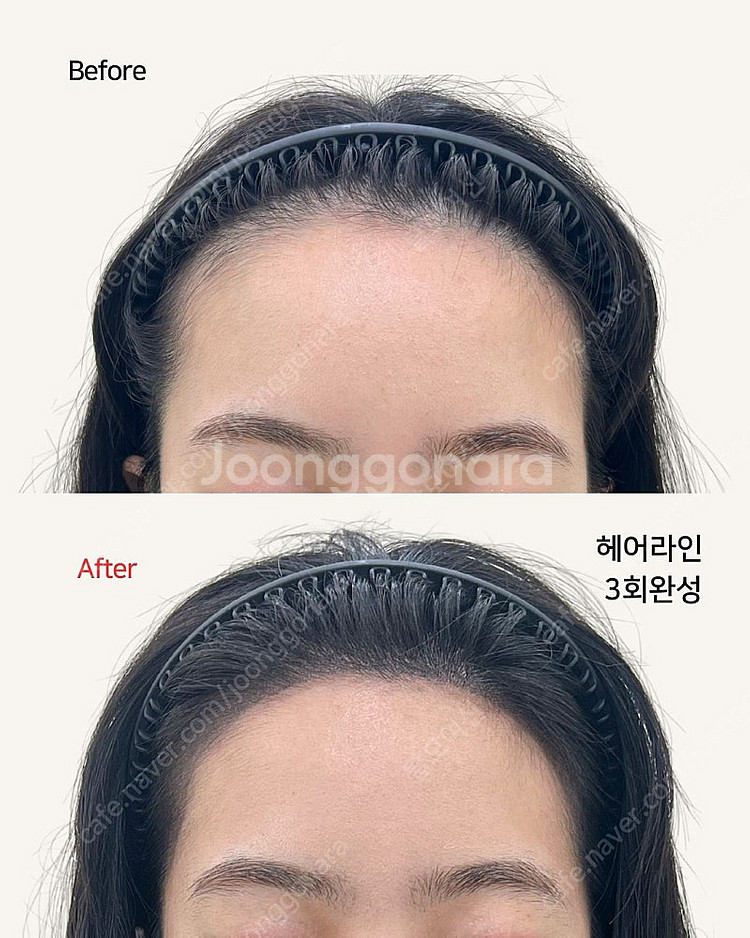 정수리, 가르마 탈모로 고민하신다면 이 상품!!--2