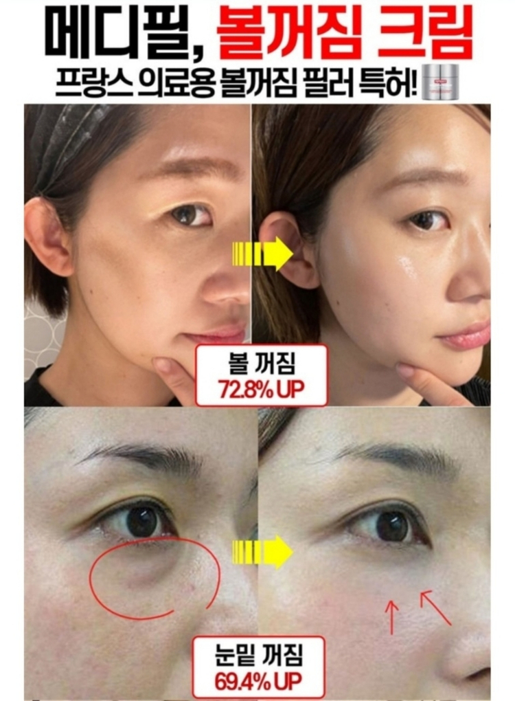 볼꺼짐 리프팅 필러 탄력 물광 보르피린 보톡스 주름개선 이미지