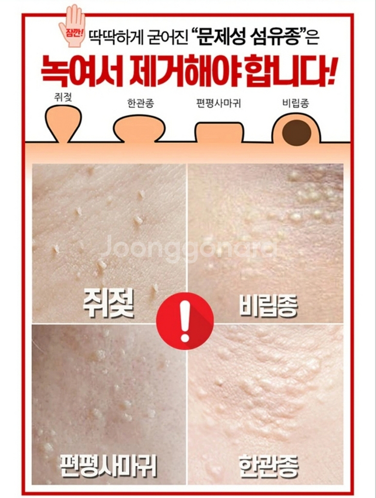 비립종 쥐젖 만능스팟 제거 편평사마귀 한관종 저자극 | 중고나라 카페에서 운영하는 공식 사이트