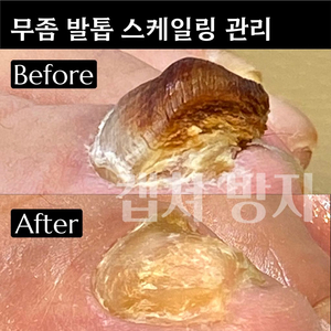 문제성 손발톱 체험(무좀/내성/발각질/물어뜯는손톱)