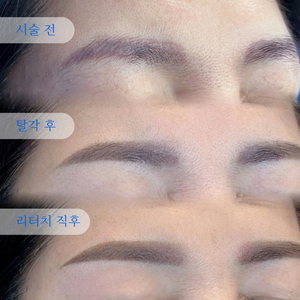 잔흔제거 또는 눈썹 모델 모집