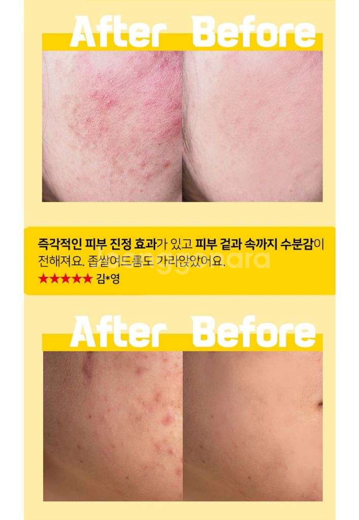 기미잡티크림 트러블크림 안면홍조크림 여드름 미백특허성분--5