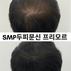 남자 정수리 두피문신 모델 구합니다(무료 시술)