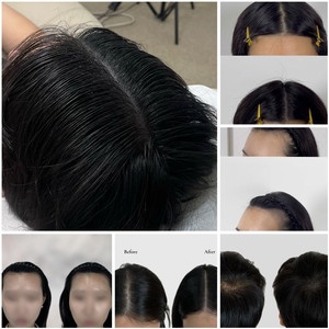 서울 서교동 합정역 탈모 커버 두피문신 모델 구합니다