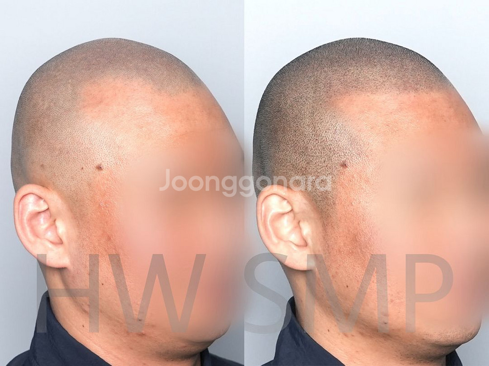 두피문신 SMP 포트폴리오 용도 모델 구합니다--0