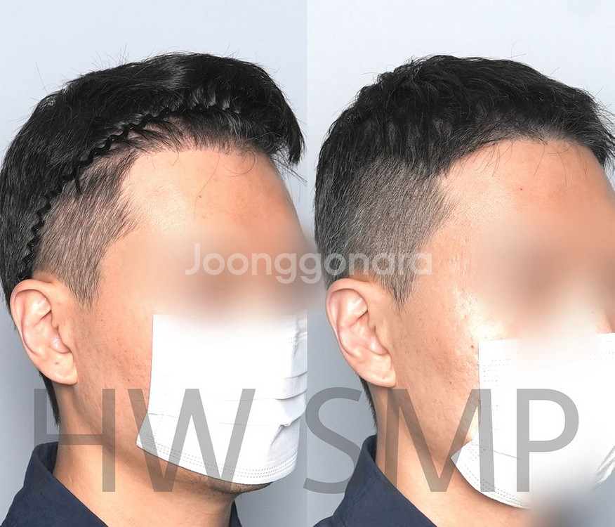 두피문신 SMP 포트폴리오 용도 모델 구합니다--1