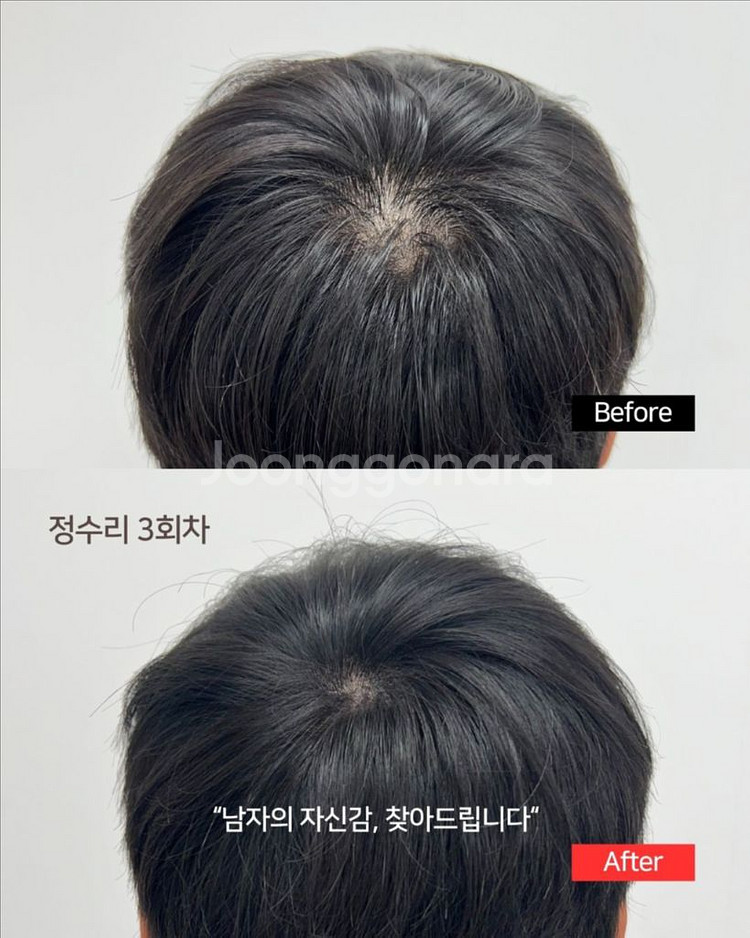 정수리, 가르마 탈모 고민 해결!!--0