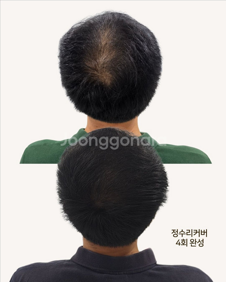 정수리, 가르마 탈모 고민 해결!!--1