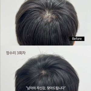 정수리, 가르마 탈모 고민해결!