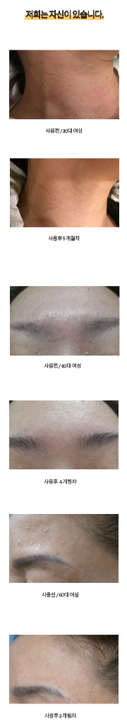 메디카미 비립종 쥐젖 편평사마귀 제거 크림--3