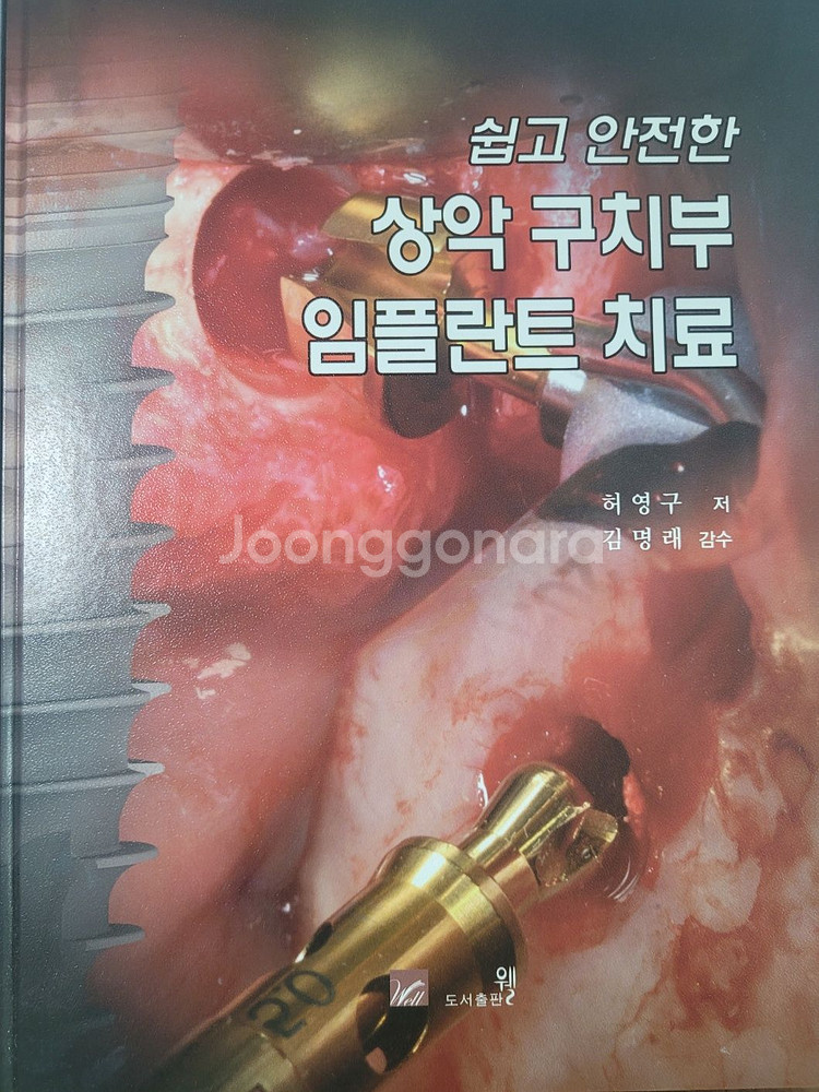 상악 구치부 임플란트 치료 (도서출판 웰)--0