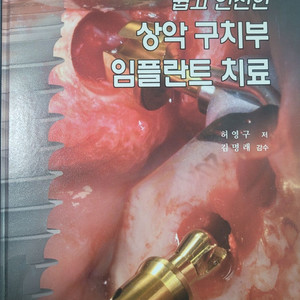 상악 구치부 임플란트 치료 (도서출판 웰)