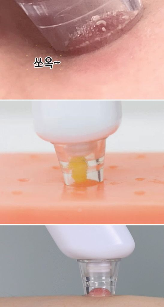 피지 흡입기 팝니다.--2