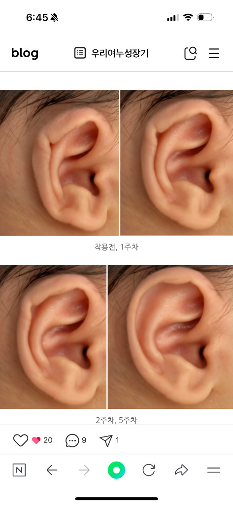 메딧트 메디톡 메디핏 신생아 귀교정기--5