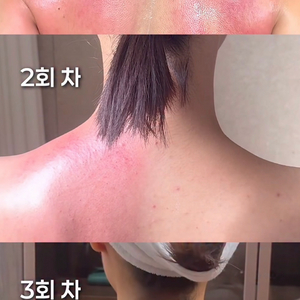 아이올 고주파 마사지기 석션 얼굴/바디