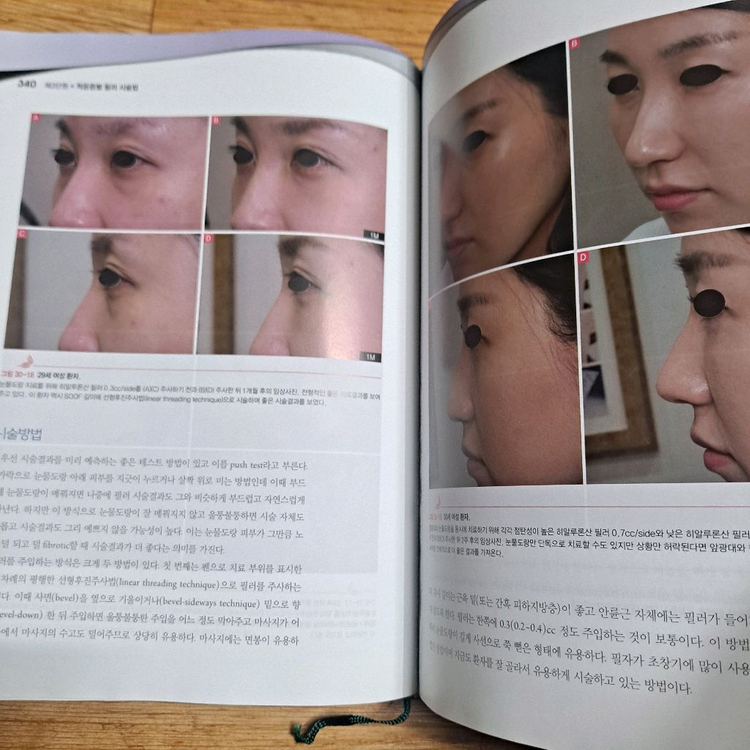 보톡스와 필러의 정석 이미지