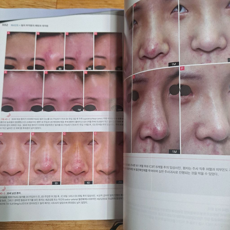 보톡스와 필러의 정석 이미지