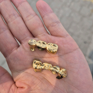 금이빨 최고가 삽니다