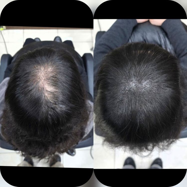 탈모 케어 이미지