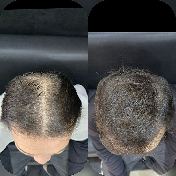 탈모 케어 이미지