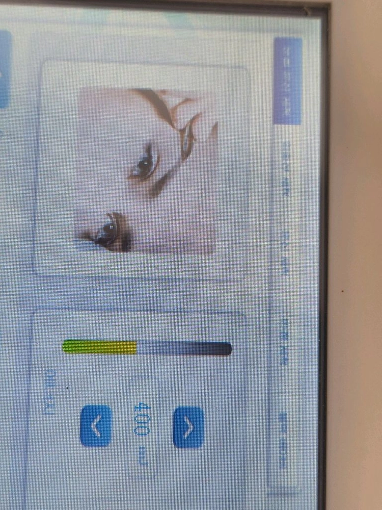 눈썹문신제거피부토닝레이저 이미지